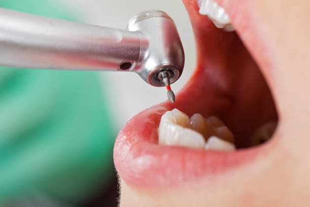 Best Emergency Dental Care for Abscessed Tooth in Saucier, MS